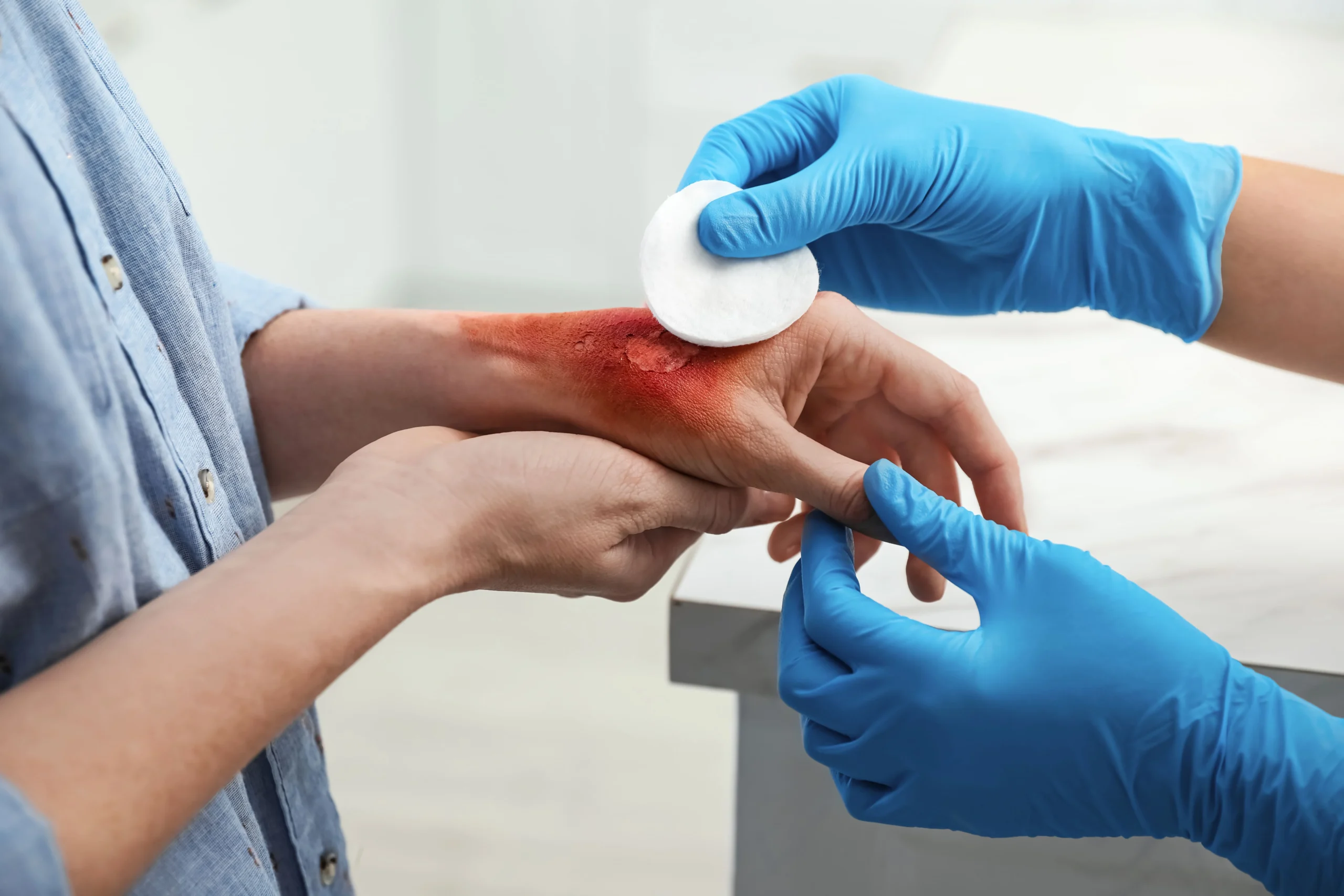 Equipos Médicos - Cuidado de Heridas - Úlceras y Quemaduras